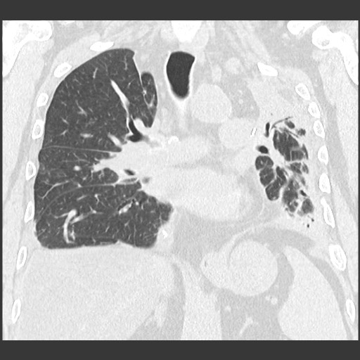 Chronic lung allograft dysfunction - restrictive form (Radiopaedia 60595-68316 Coronal lung window 59).jpg