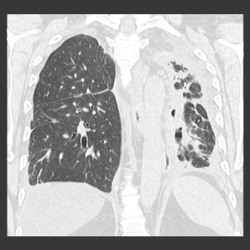 Chronic lung allograft dysfunction - restrictive form (Radiopaedia 60595-68316 Coronal lung window 68).jpg
