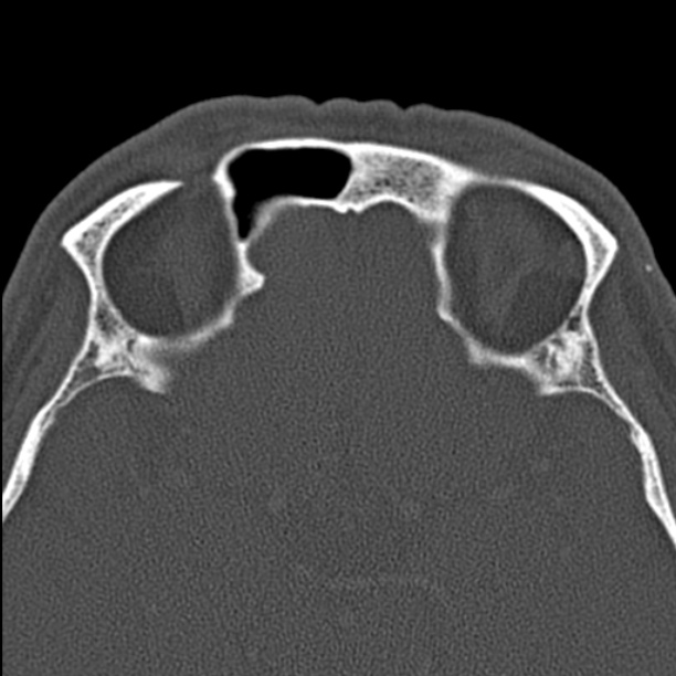 Chronic maxillary sinusitis (Radiopaedia 27879-28116 Axial bone window 44).jpg