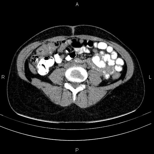 Chronic pancreatitis (Radiopaedia 64576-73450 Axial non-contrast 99).jpg