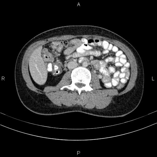 File:Chronic pancreatitis (Radiopaedia 64576-73450 C 85).jpg