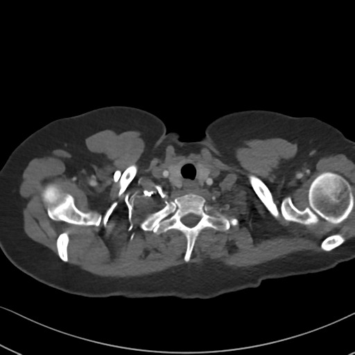 Chronic pulmonary embolus (Radiopaedia 39129-41341 Axial C+ CTPA 8).png