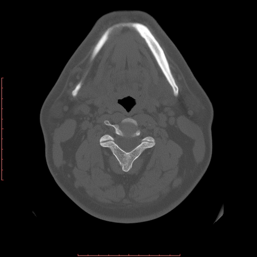 Chronic submandibular sialolithiasis (Radiopaedia 69817-79814 Axial bone window 80).jpg
