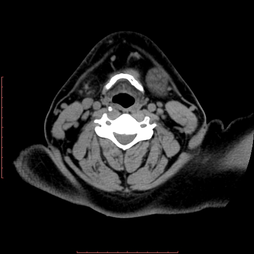 Chronic submandibular sialolithiasis (Radiopaedia 69817-79814 Axial non-contrast 148).jpg
