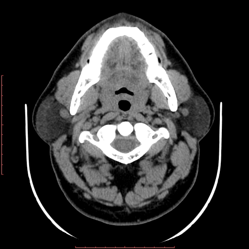 Chronic submandibular sialolithiasis (Radiopaedia 69817-79814 Axial non-contrast 71).jpg