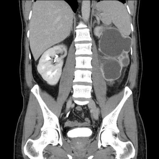 Chronic ureteropelvic junction obstruction (Radiopaedia 78365-90996 B 62).jpg