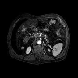 Cirrhosis and hepatocellular carcinoma in the setting of hemochromatosis (Radiopaedia 75394-86594 Axial T1 C+ fat sat 127).jpg