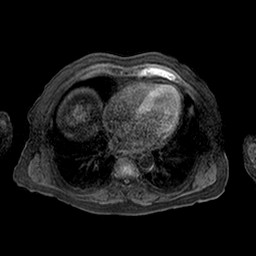 Cirrhosis and hepatocellular carcinoma in the setting of hemochromatosis (Radiopaedia 75394-86594 Axial T1 C+ fat sat 80).jpg