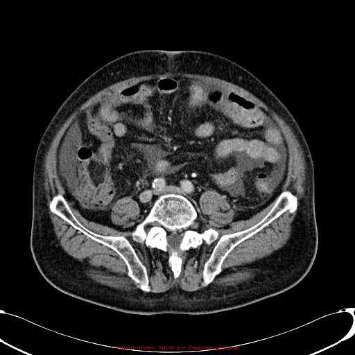 File:Cirrhosis and hepatocellular carcinoma in the setting of hemochromatosis (Radiopaedia 75394-86595 B 60).jpg