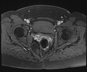 File:Class II Mullerian duct anomaly- unicornuate uterus with rudimentary horn and non-communicating cavity (Radiopaedia 39441-41755 Axial T1 fat sat 100).jpg