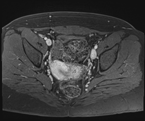 File:Class II Mullerian duct anomaly- unicornuate uterus with rudimentary horn and non-communicating cavity (Radiopaedia 39441-41755 Axial T1 fat sat 68).jpg