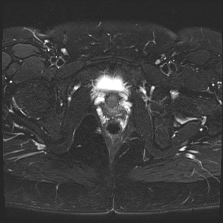 File:Class II Mullerian duct anomaly- unicornuate uterus with rudimentary horn and non-communicating cavity (Radiopaedia 39441-41755 Axial T2 fat sat 24).jpg