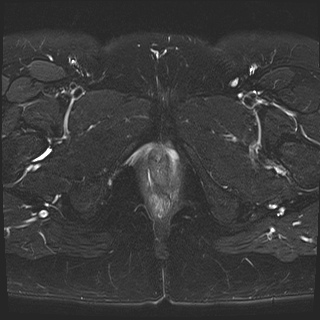 File:Class II Mullerian duct anomaly- unicornuate uterus with rudimentary horn and non-communicating cavity (Radiopaedia 39441-41755 Axial T2 fat sat 28).jpg