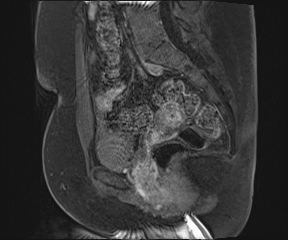 File:Class II Mullerian duct anomaly- unicornuate uterus with rudimentary horn and non-communicating cavity (Radiopaedia 39441-41755 G 61).jpg