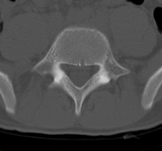 Clear cell meningoma - lumbar spine (Radiopaedia 60116-67691 Axial bone window 60).png