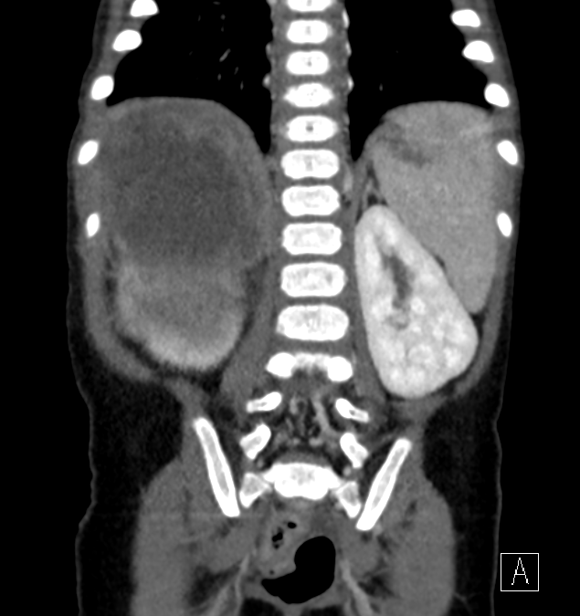 Clear cell sarcoma of kidney (Radiopaedia 60647-68379 C 49).png
