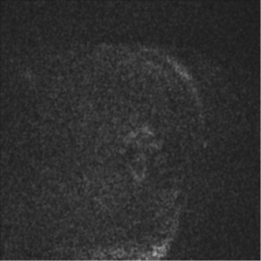 Clival chordoma invading the hypoglossal canal (Radiopaedia 48850-53887 Sagittal T1 95).png
