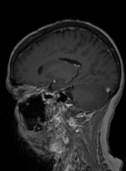 Clival meningioma (Radiopaedia 53278-59248 Sagittal T1 C+ 289).jpg
