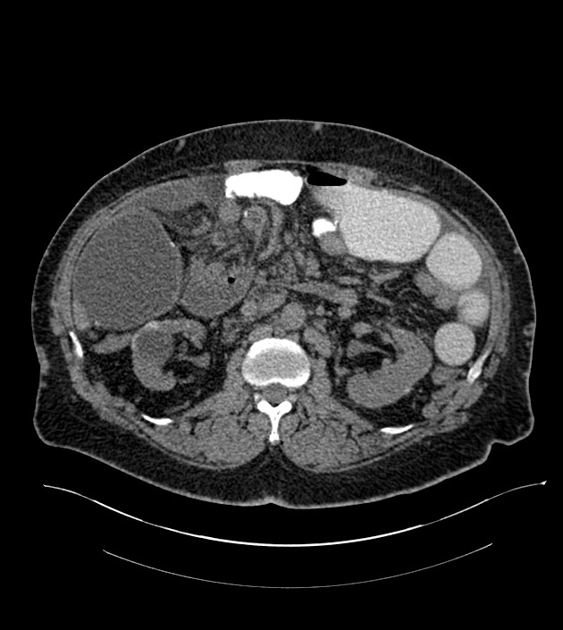 Closed-loop small bowel obstruction-internal hernia (Radiopaedia 78439-91096 Axial non-contrast 67).jpg