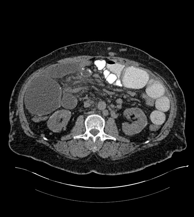 Closed-loop small bowel obstruction-internal hernia (Radiopaedia 78439-91096 Axial non-contrast 73).jpg