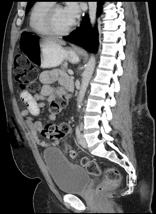 Closed loop obstruction - internal hernia into nephrectomy bed (Radiopaedia 59867-67320 C 40).jpg