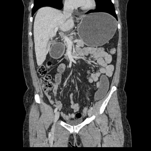 File:Closed loop small bowel obstruction (Radiopaedia 65403-74451 B 49).jpg
