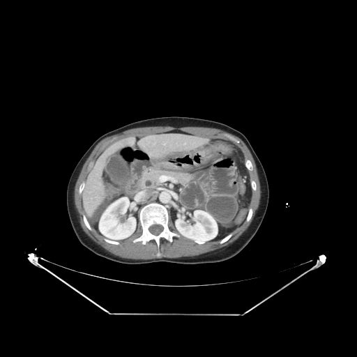 Closed loop small bowel obstruction (Radiopaedia 68471-78022 A 92).jpg
