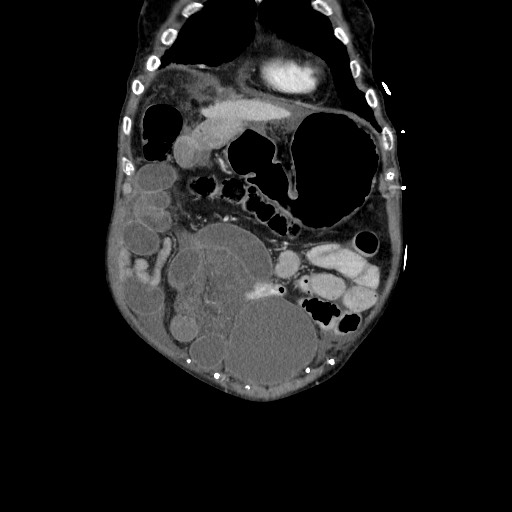 Closed loop small bowel obstruction - adhesive disease and hemorrhagic ischemia (Radiopaedia 86831-102990 B 33).jpg