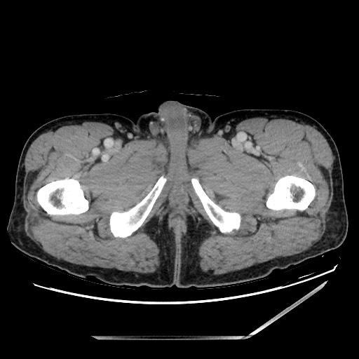 Closed loop small bowel obstruction - omental adhesion causing "internal hernia" (Radiopaedia 85129-100682 A 187).jpg
