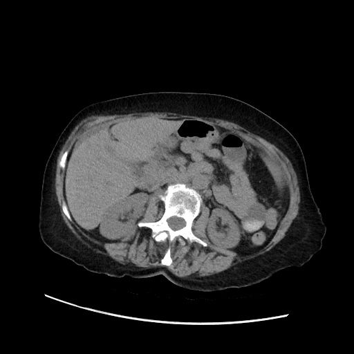 Closed loop small bowel obstruction due to adhesive band, with intramural hemorrhage and ischemia (Radiopaedia 83831-99017 Axial non-contrast 67).jpg