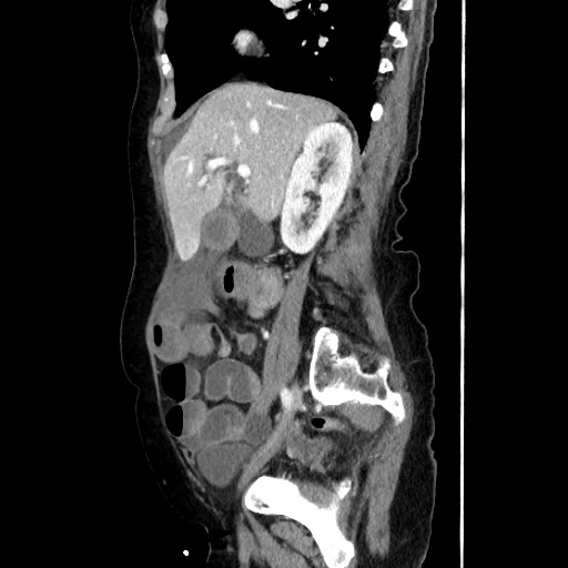 Closed loop small bowel obstruction due to adhesive band, with intramural hemorrhage and ischemia (Radiopaedia 83831-99017 D 80).jpg