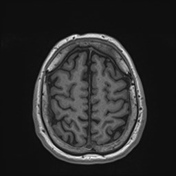 Cochlear incomplete partition type III associated with hypothalamic hamartoma (Radiopaedia 88756-105498 Axial T1 158).jpg