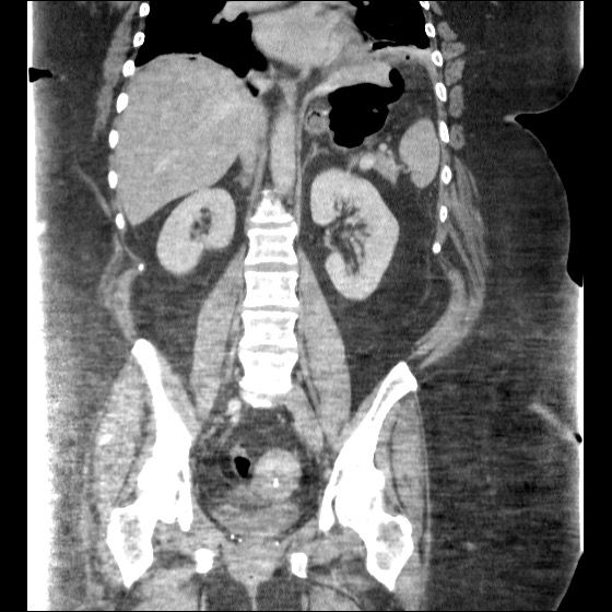 File:Collection due to leak after sleeve gastrectomy (Radiopaedia 55504-61972 B 30).jpg
