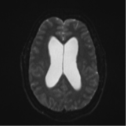 Colloid cyst (Radiopaedia 53164-59125 Axial DWI 18).png