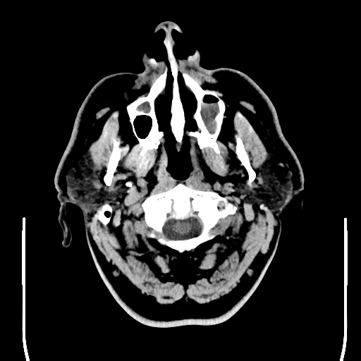 File:Colloid cyst (large) (Radiopaedia 34415-35734 Axial non-contrast 5).png