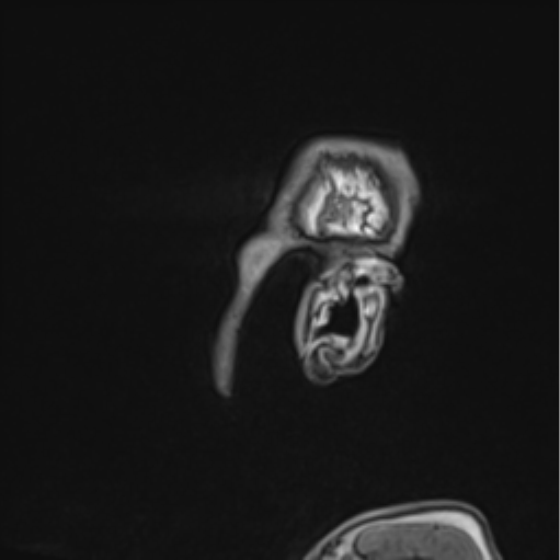 File:Colloid cyst of the third ventricle (Radiopaedia 86571-102662 Sagittal T1 77).png