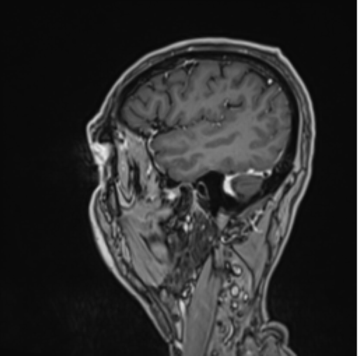 Colloid cyst of the third ventricle (Radiopaedia 86571-102662 Sagittal T1 C+ 15).png