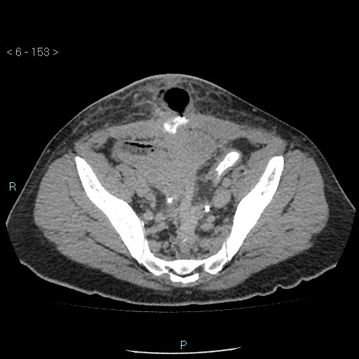 File:Colo-cutaneous fistula (Radiopaedia 40531-43129 A 64).jpg