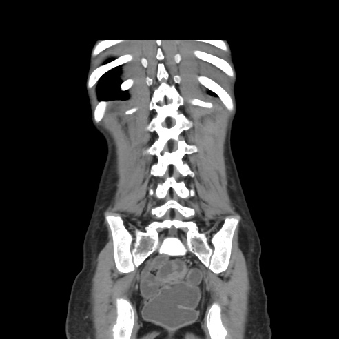 File:Colocolic fistula - Crohn disease (Radiopaedia 57063-63955 B 37).jpg