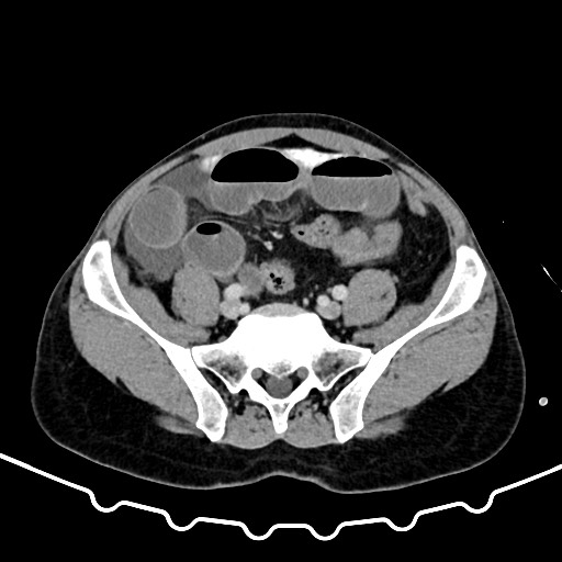 Colocolic intussusception due to large lipoma (Radiopaedia 68773-78482 A 140).jpg