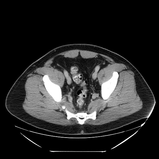 Colocolic intussusception due to lipoma (Radiopaedia 73712-84508 A 100).jpg