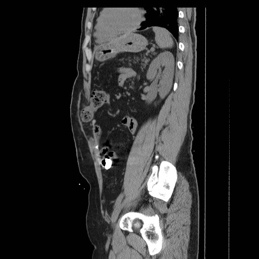 Colocutaneous fistula in Crohn's disease (Radiopaedia 29586-30093 F 33).jpg