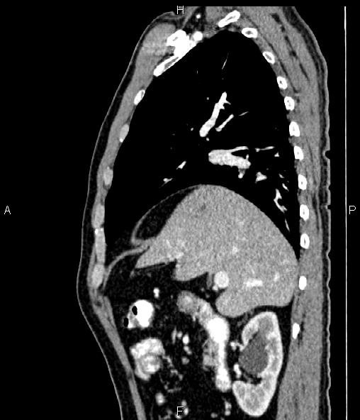 Colon adenocarcinoma (Radiopaedia 83266-97671 D 39).jpg