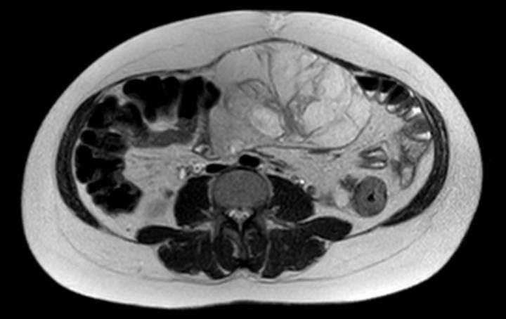 Colon adenocarcinoma with Krukenberg tumors, advanced pregnancy (Radiopaedia 67279-76645 Axial T2 39).jpg