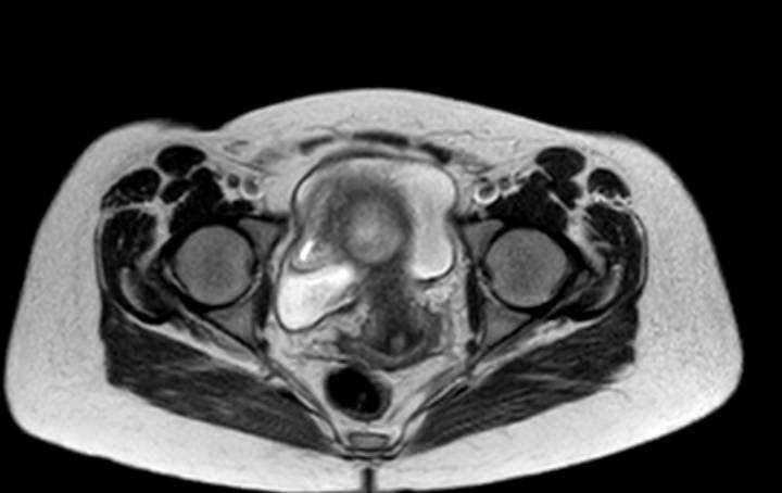 Colon adenocarcinoma with Krukenberg tumors, advanced pregnancy (Radiopaedia 67279-76645 Axial T2 8).jpg