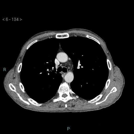 File:Colonic cancer (ultrasound and TC imaging) (Radiopaedia 50346-55713 B 134).jpg