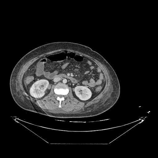 Colonic infarction after colostomy creation (Radiopaedia 81157-94797 A 86).jpg
