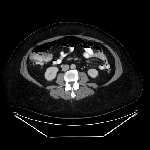 File:Colonic intussusception due to adenocarcinoma (Radiopaedia 86828-102987 A 79).jpg