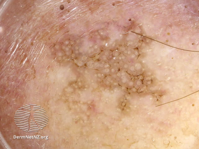File:Dermoscopy of actinic keratosis (DermNet NZ doctors-dermoscopy-course-images-white-circles).jpg