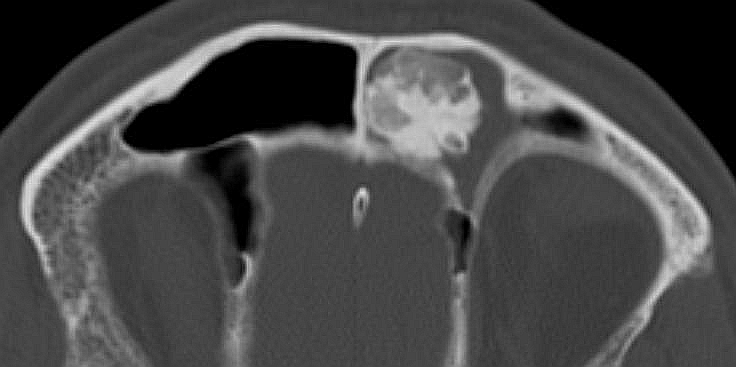 File:Frontal sinus osteoma (Radiopaedia 15890).jpg